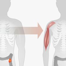 An illustration showing reduction in muscle mass and weight from cachexia.