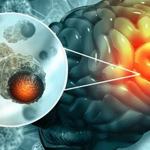 Medical illustration of brain cancer with a microscopic magnification of malignant cells dividing in the tumor microenvironment.