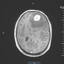 black-and-white brain scan showing tumor