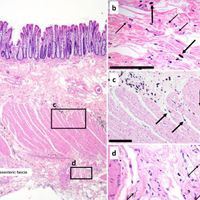 interstitium interstitial space cancer macrophage human anatomy