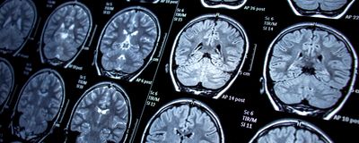 Multiple panels of a magnetic resonance imaging brain scan.