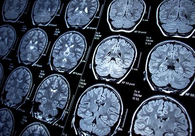 Multiple panels of a magnetic resonance imaging brain scan.