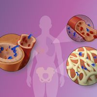 Infographic: Steps in Cancer Metastasis