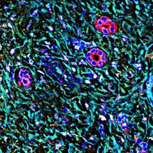 Image of the tissue surrounding a pancreatic tumor thickening and scarring.