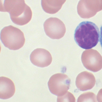 Chronic lymphocytic leukemia